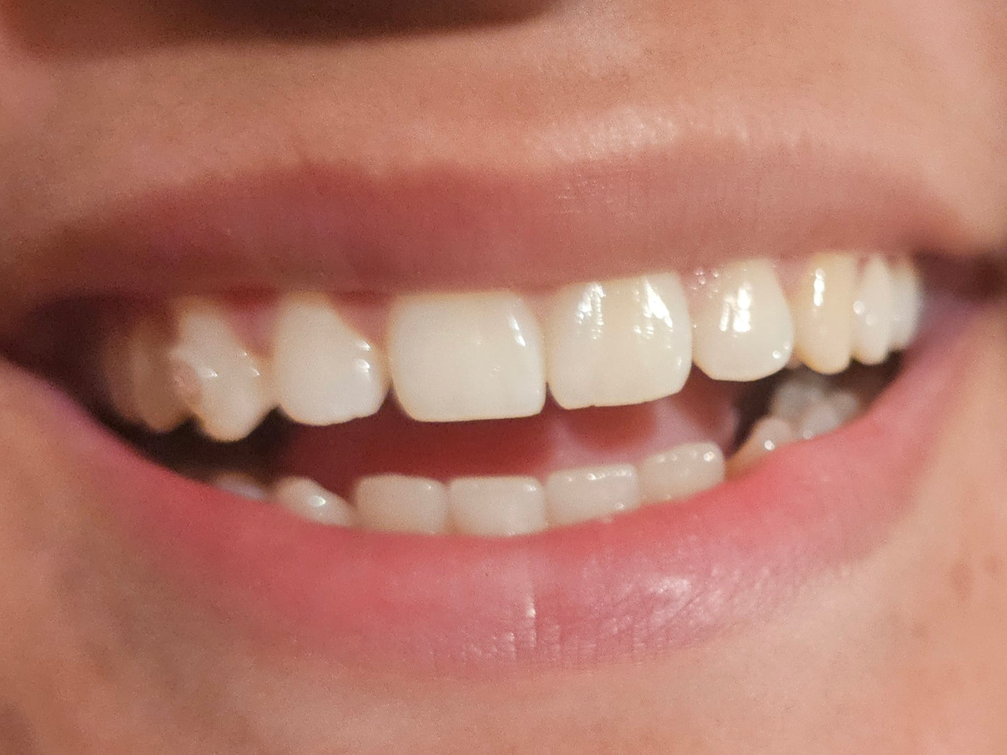 Teeth Whitening Express Treatment ✨️