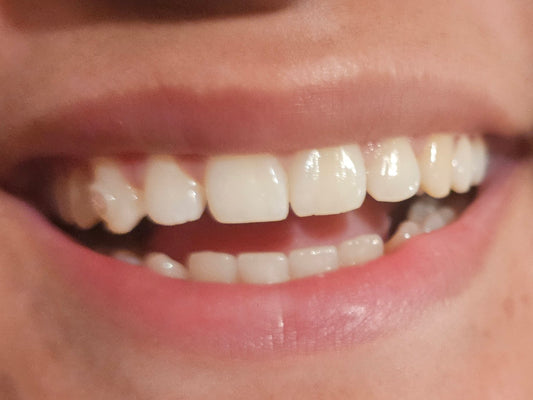 Teeth Whitening Express Treatment ✨️
