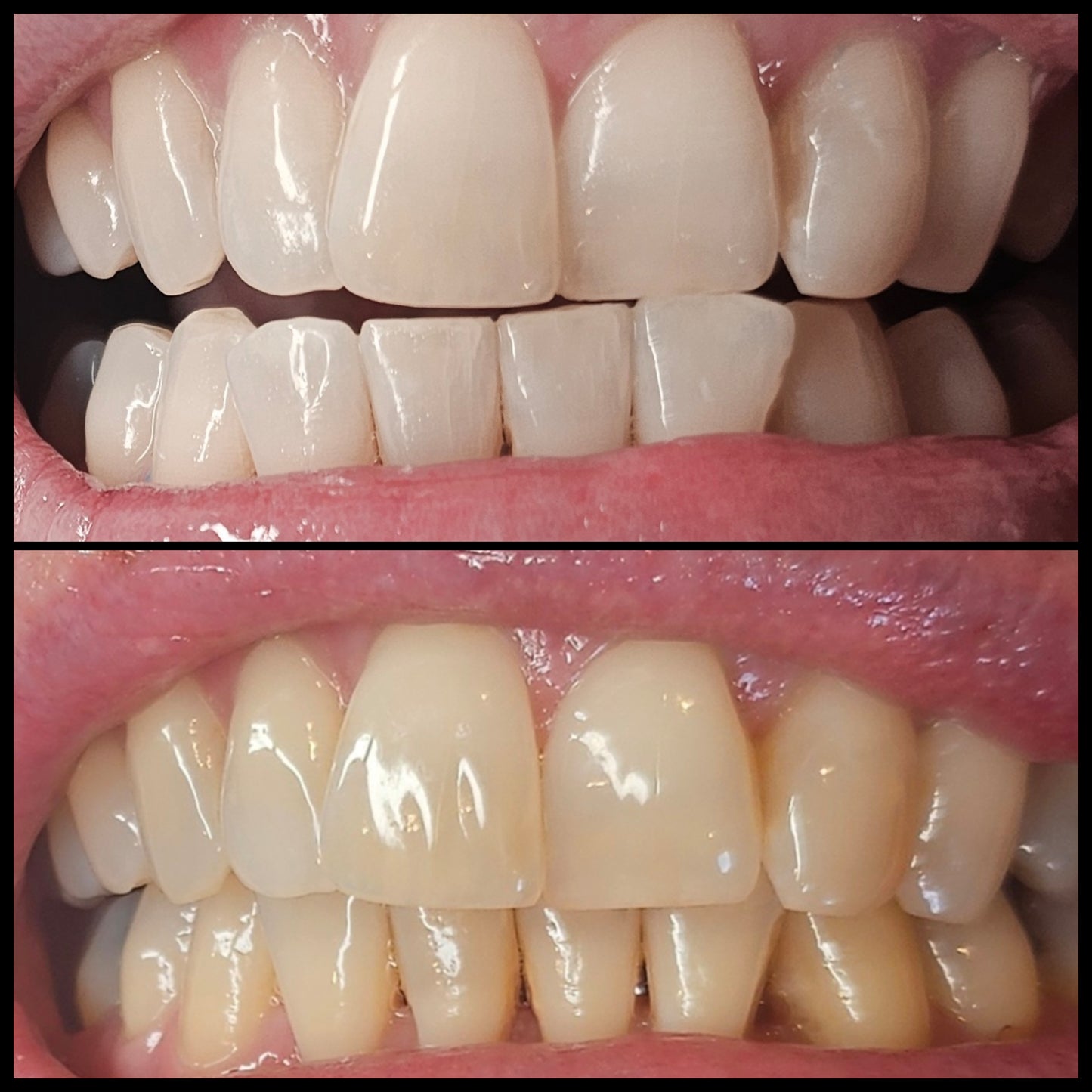 Teeth Whitening Double Treatment ✨️