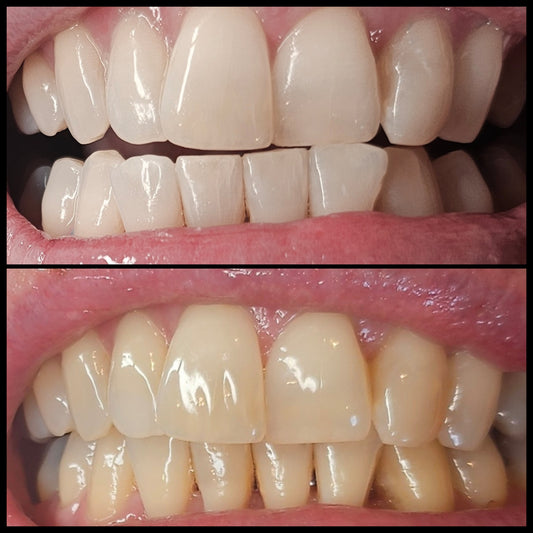Teeth Whitening Double Treatment ✨️
